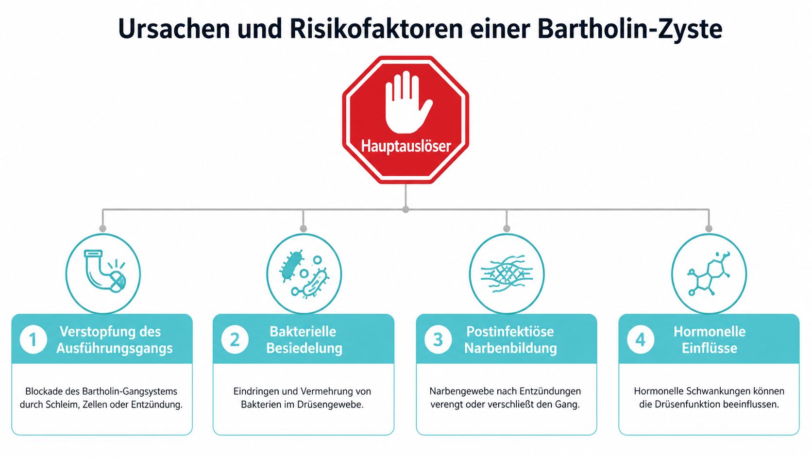 Eine Infografik zeigt die vier Hauptursachen und Risikofaktoren für die Entstehung einer Bartholin-Zyste im weiblichen Genitalbereich.